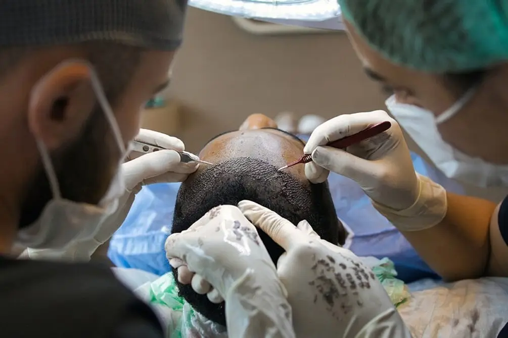 Hair transplant surgery in Turkey