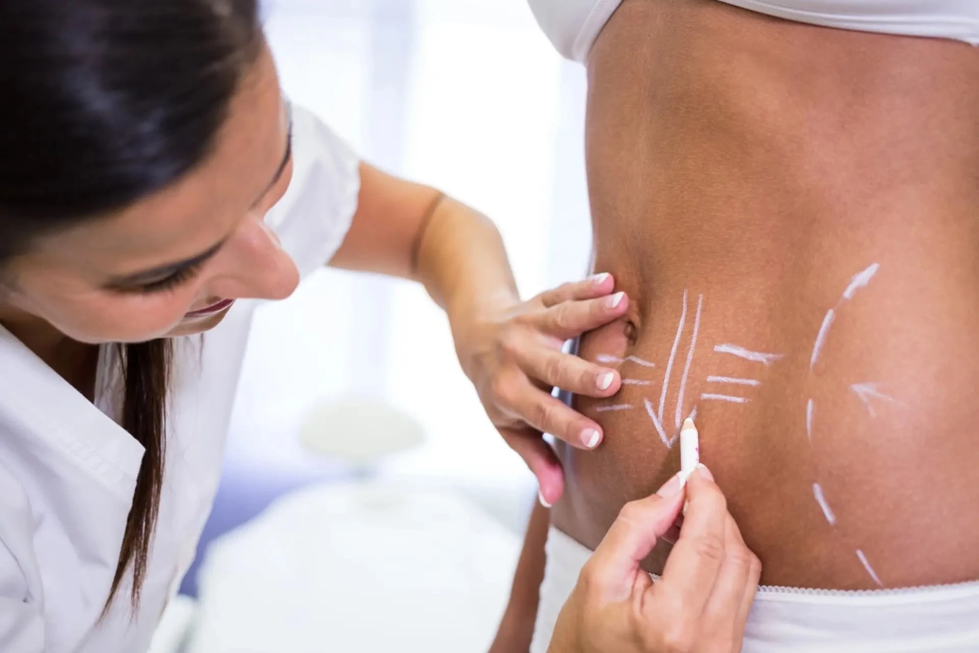 Tummy Tuck Before Drawing Lines Womans Abdomen Liposuction Cellulite Removal
